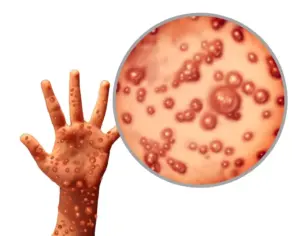 monkeypox